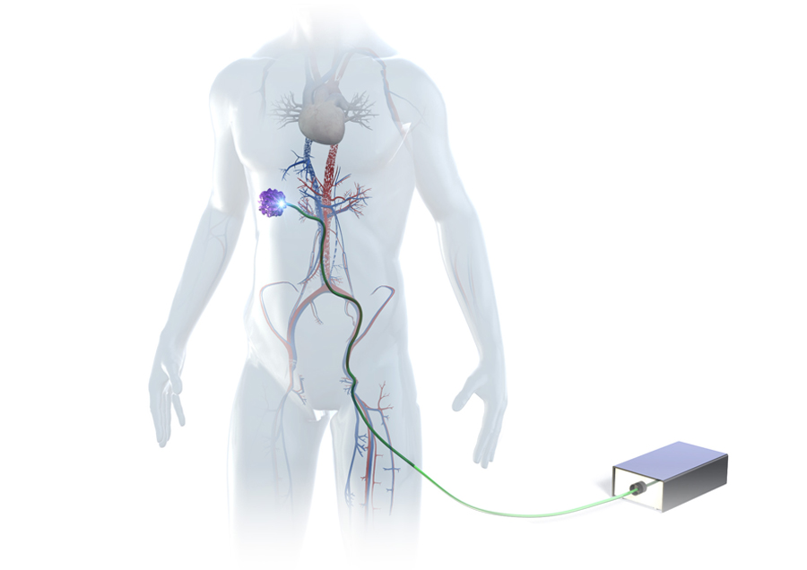 Development of the world's first treatment method to deliver light deep inside the body from within blood vessels